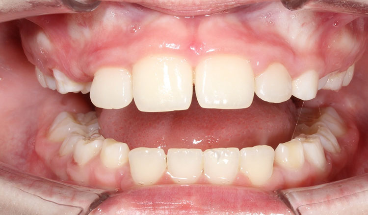 Phase I orthodontic treatment after - patient 7