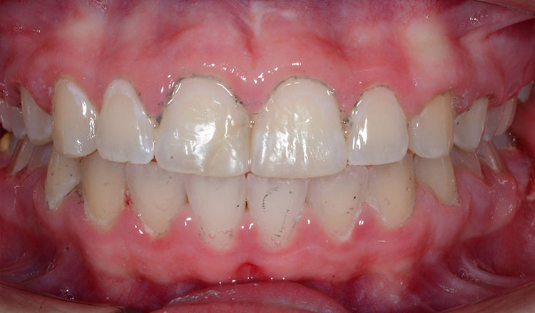 Class II orthodontic treatment after - patient 7