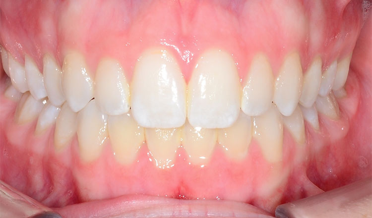 Combo TX orthodontic treatment before - patient 7