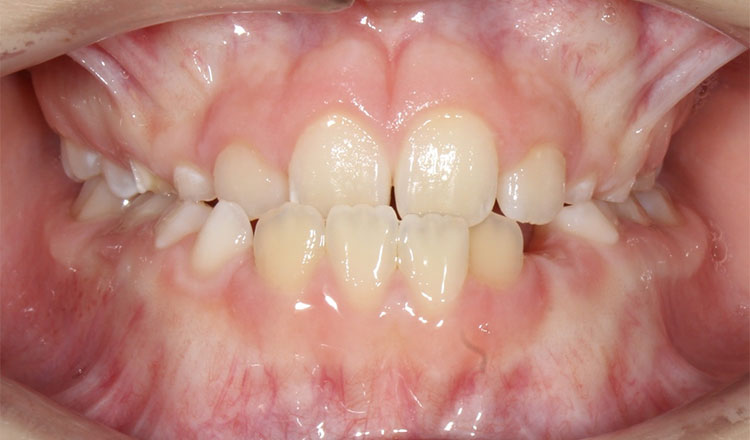 Crossbite orthodontic treatment before - patient 7