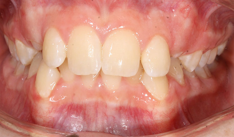 Crowding orthodontic treatment before - patient 7