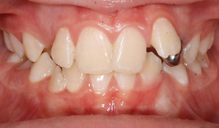 Impacted Canines orthodontic treatment before - patient 7