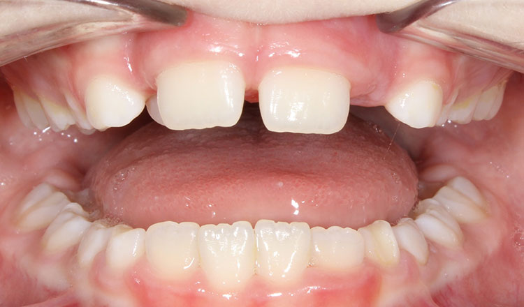 Phase I orthodontic treatment before - patient 7