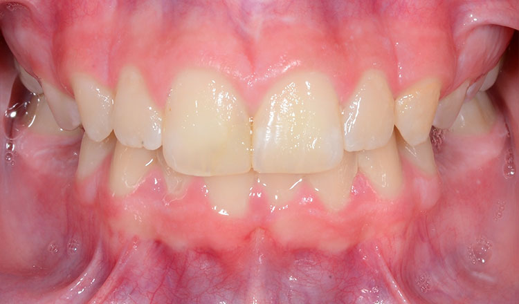 Class II orthodontic treatment before - patient 7