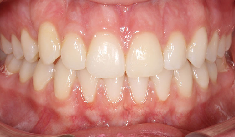 Impacted Canines orthodontic treatment after - patient 8