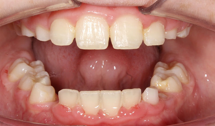 Phase I orthodontic treatment after - patient 8