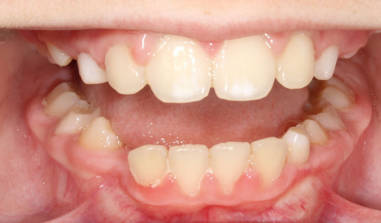 Crowding orthodontic treatment after - patient 8