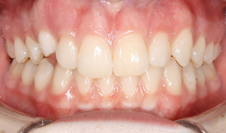Impacted Canines orthodontic treatment before - patient 8