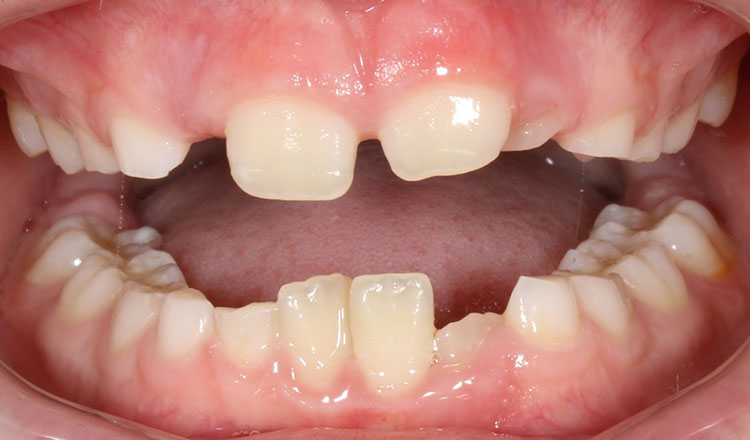 Phase I orthodontic treatment before - patient 8