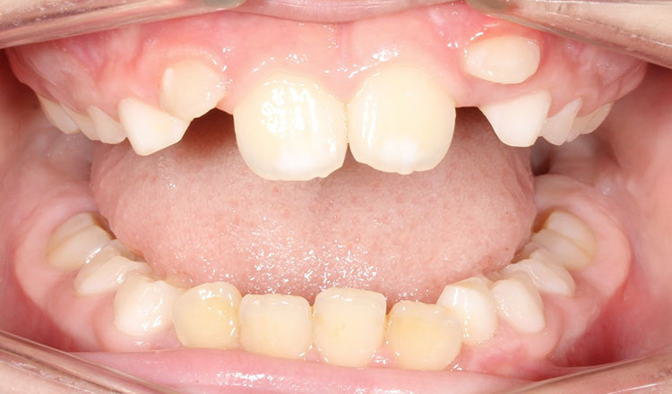 Crowding orthodontic treatment before - patient 8