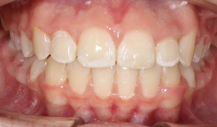 Phase I orthodontic treatment after - patient 9