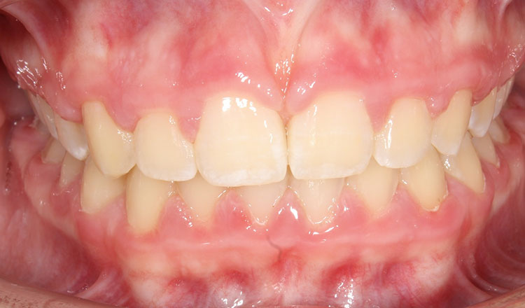 Impacted Canines orthodontic treatment after - patient 9