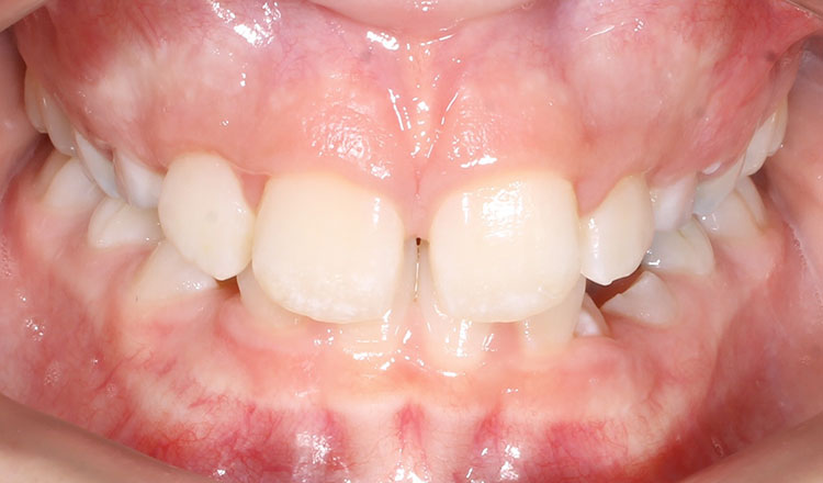 Phase I orthodontic treatment before - patient 9