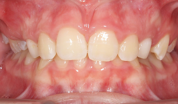 Impacted Canines orthodontic treatment before - patient 9